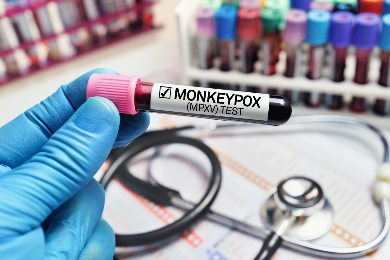 First Confirmed Case of Monkeypox Identified in San Luis Valley