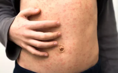 Public Health Alert: Measles Outbreak Concerns for Colorado Travelers