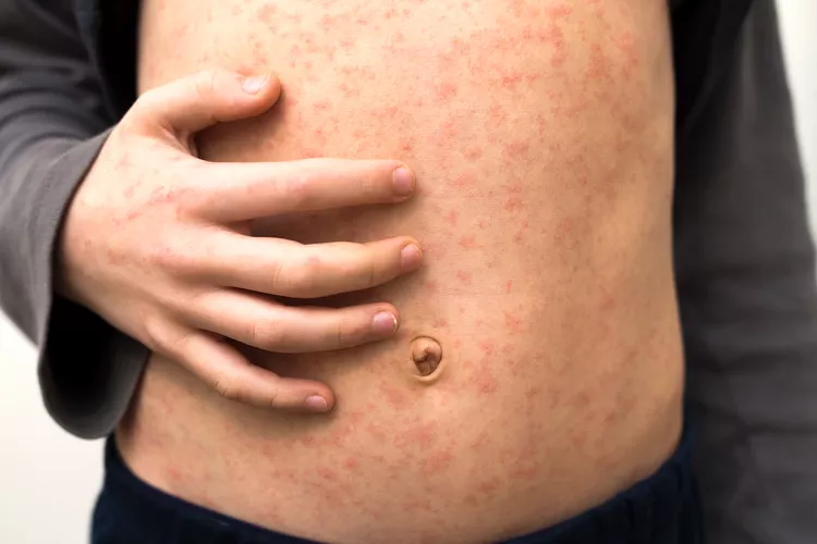 Public Health Alert: Measles Outbreak Concerns for Colorado Travelers